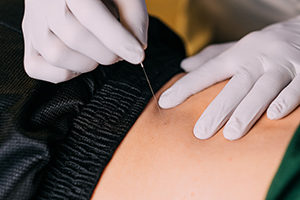 Roswell Physical Therapy Dry Needling